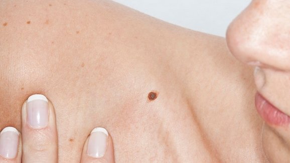 En el mundo, se diagnostican hasta 3 millones de casos de cáncer de piel al año