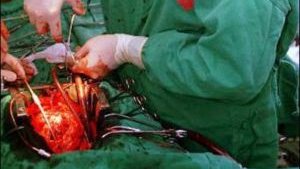 China pondrá fin a los trasplantes con órganos de ejecutados en cinco años