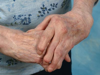 Artritis afecta a chihuahuenses